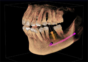 原デンタルケアクリニックでは歯科用CTを利用してインプラント治療のシミュレーションを行ってから施述をすることが可能です