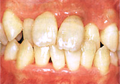 歯周病治療後